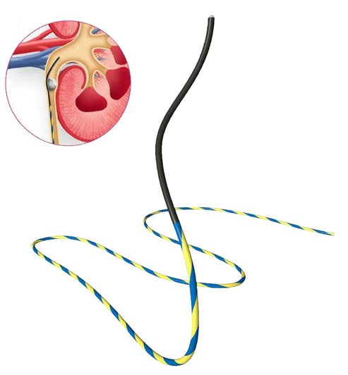 Zebra Guide Wire - Rocawire